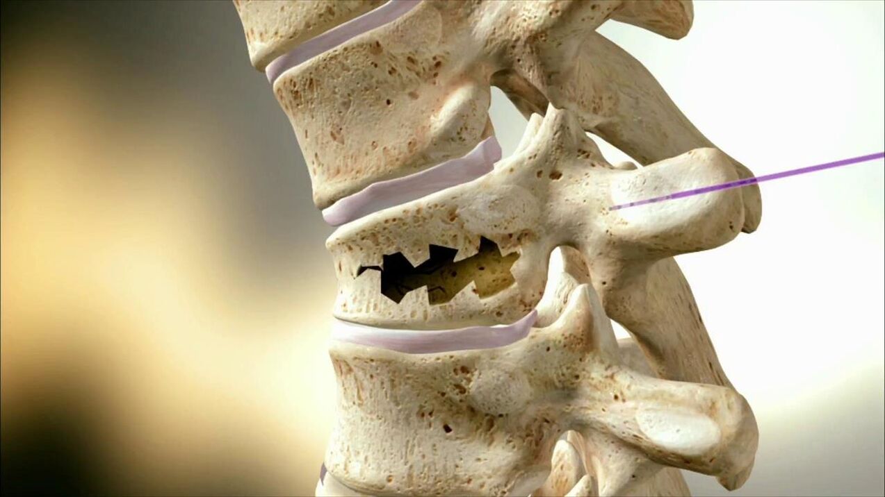 Damaged spine