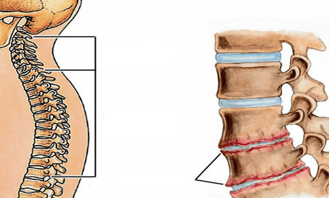 What does osteochondrosis of the spine look like