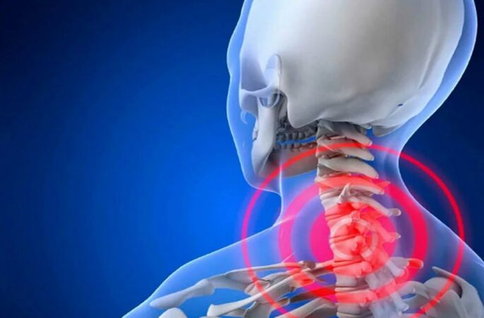 Osteochondrosis of the cervical spine