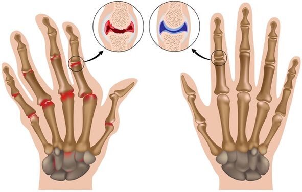Deformation of the fingers due to osteoarthritis