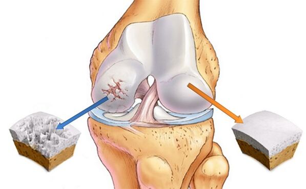 healthy cartilage affected by osteoarthritis