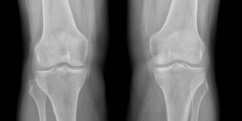 Knee osteoarthritis on x-ray