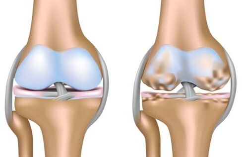 healthy joint and destruction of the knee joint due to osteoarthritis