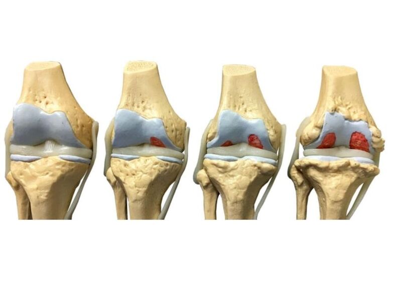 Degree of arthrosis of the joints