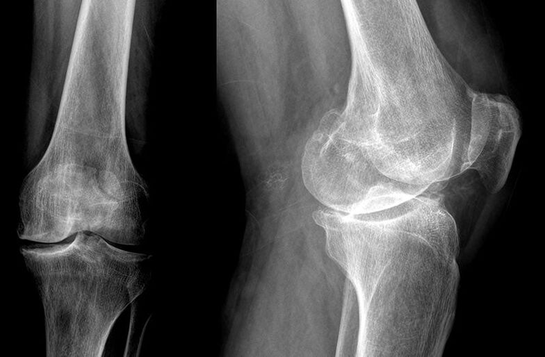 Diagnosis of joint osteoarthritis